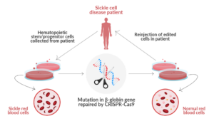 First CRISPR Gene Editing Treatment for Sickle Cell Disease - EDITSCD