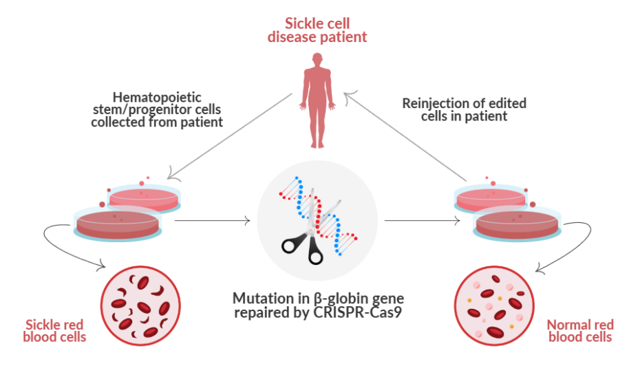 First Crispr Gene Editing Treatment For Sickle Cell Disease Editscd